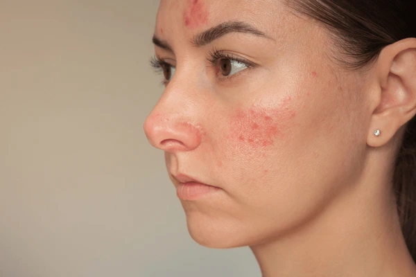 5 Ciri Jerawat karena Tidak Cocok Skincare dan Cara Mengatasinya