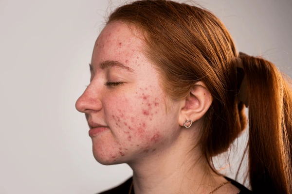 Basic Skincare untuk Kulit Berjerawat dan 5 Langkah Wajib yang Tidak Boleh Dilewatkan