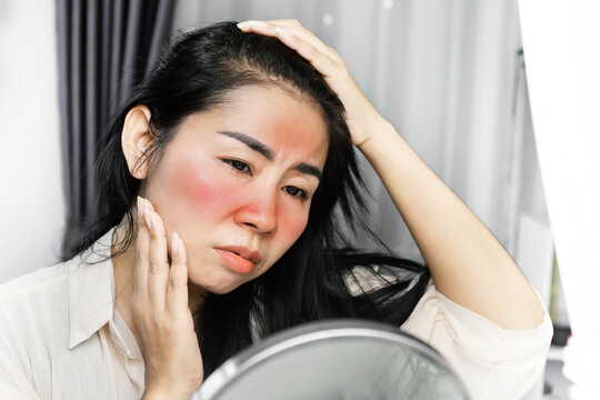 Sunburn adalah Musuh Kulit Nomor Satu: Cara Cepat Mengatasi Kulit Terbakar Matahari dan Cara Mencegahnya 
