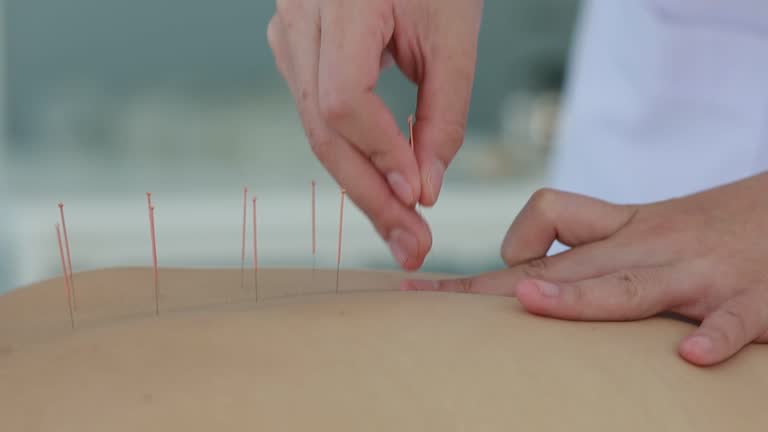 Terapi Akupuntur Sebagai Rahasia Pengobatan Timur untuk Hidup Sehat dan Bebas Nyeri